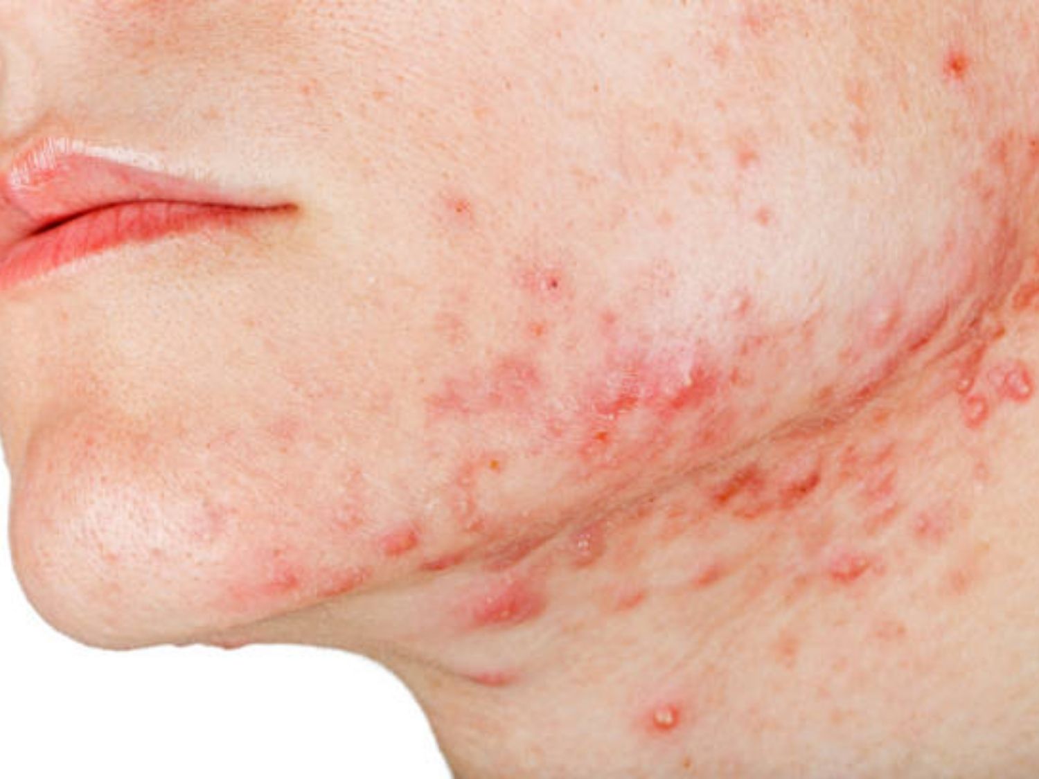 mụn viêm lan rộng xuống cổ