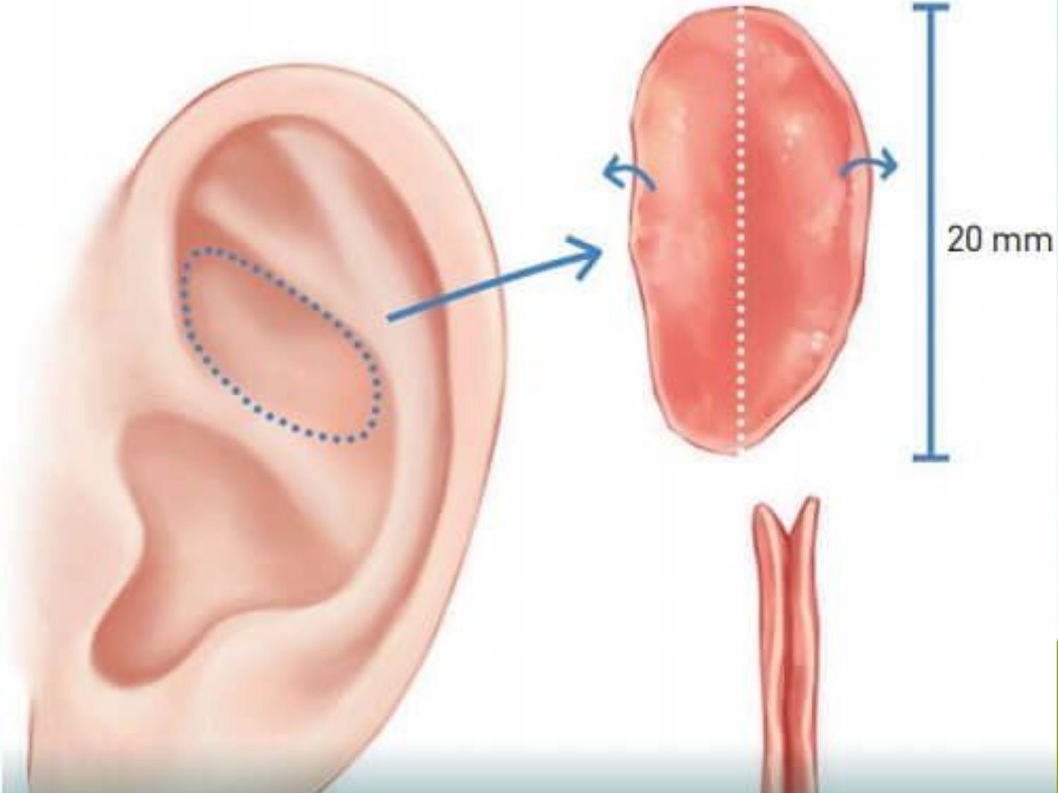 sụn vành tai có độ mềm dẻo, đàn hồi và độ cong tự nhiên
