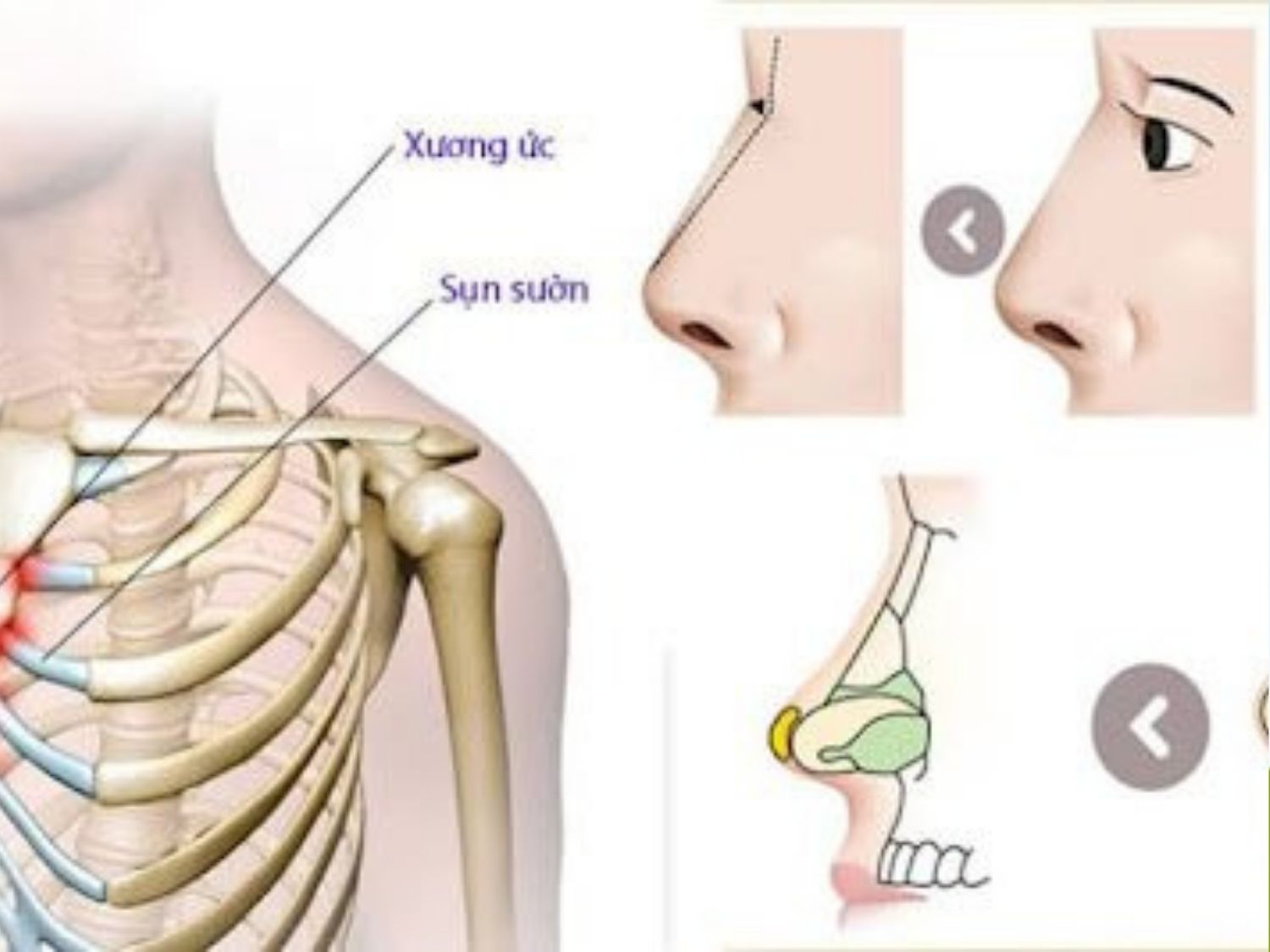 sụn sườn có độ chắc, nguồn vật liệu tương đối dồi dào