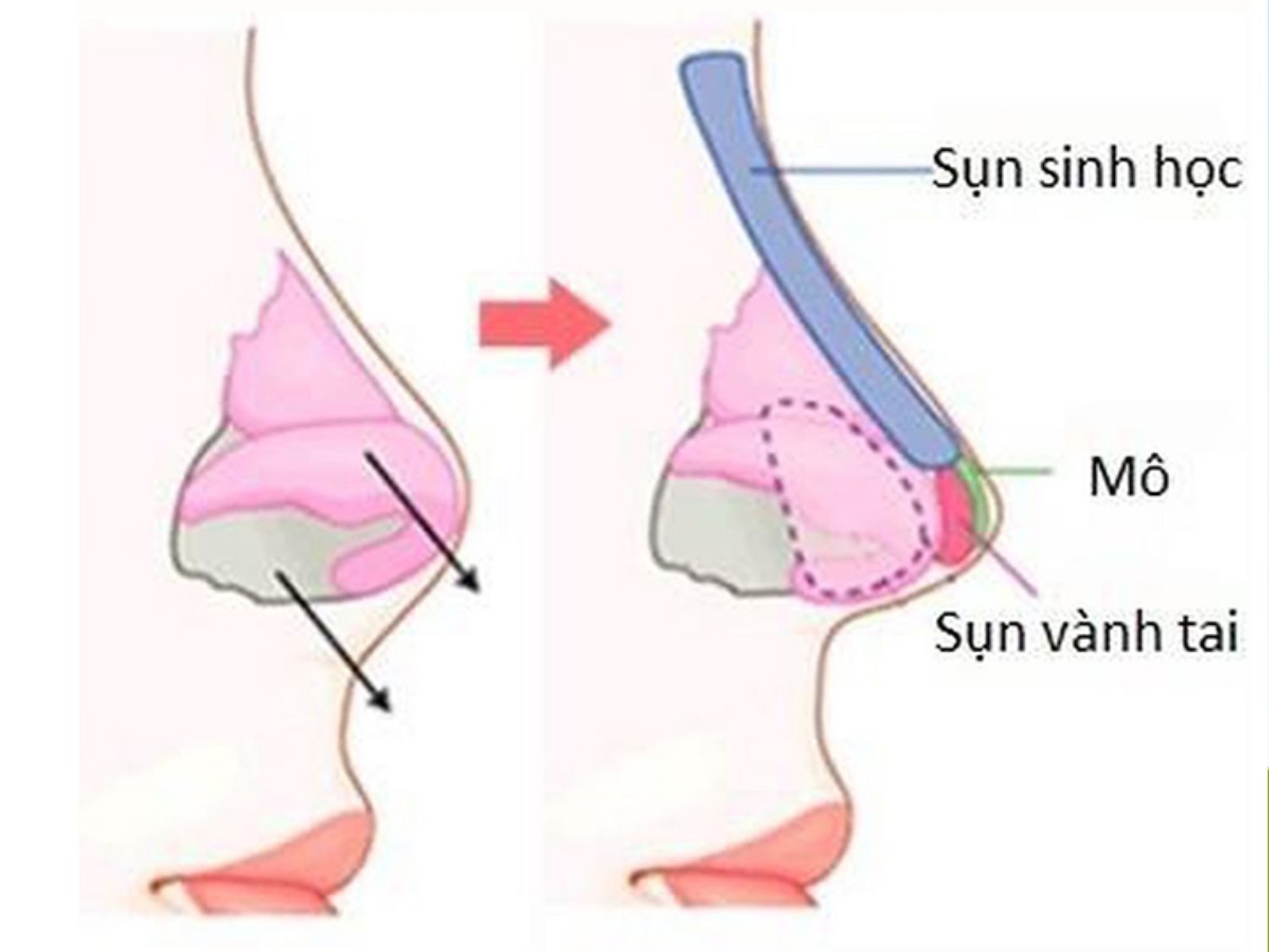 Nâng mũi bọc sụn tự thân là phương pháp kết hợp sụn sinh học nhân tạo dùng để nâng cao phần sống mũi và sụn tự thân dùng