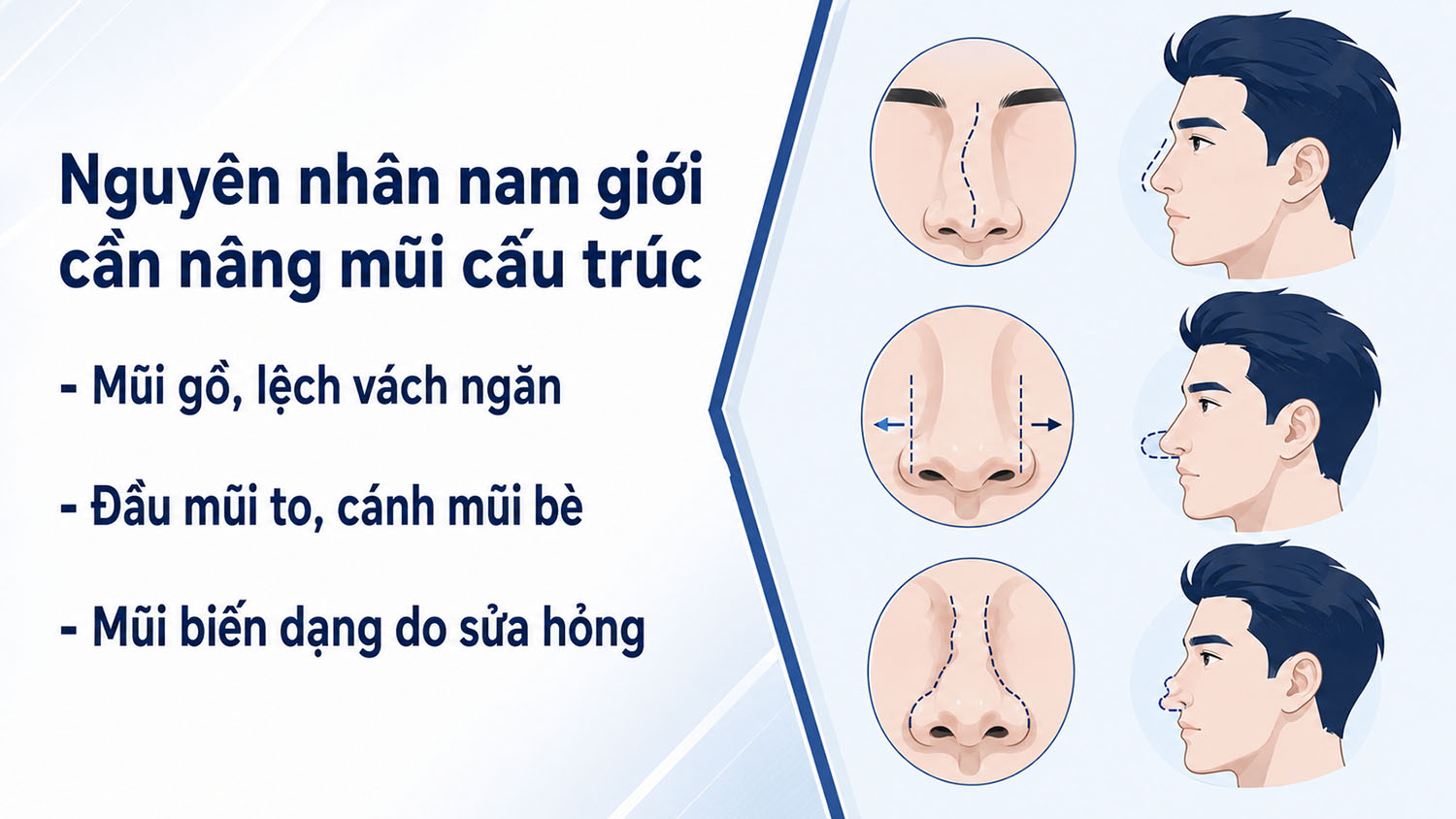 ảnh mô tả các Nguyên nhân khiến nam giới cần can thiệp nâng mũi cấu trúc