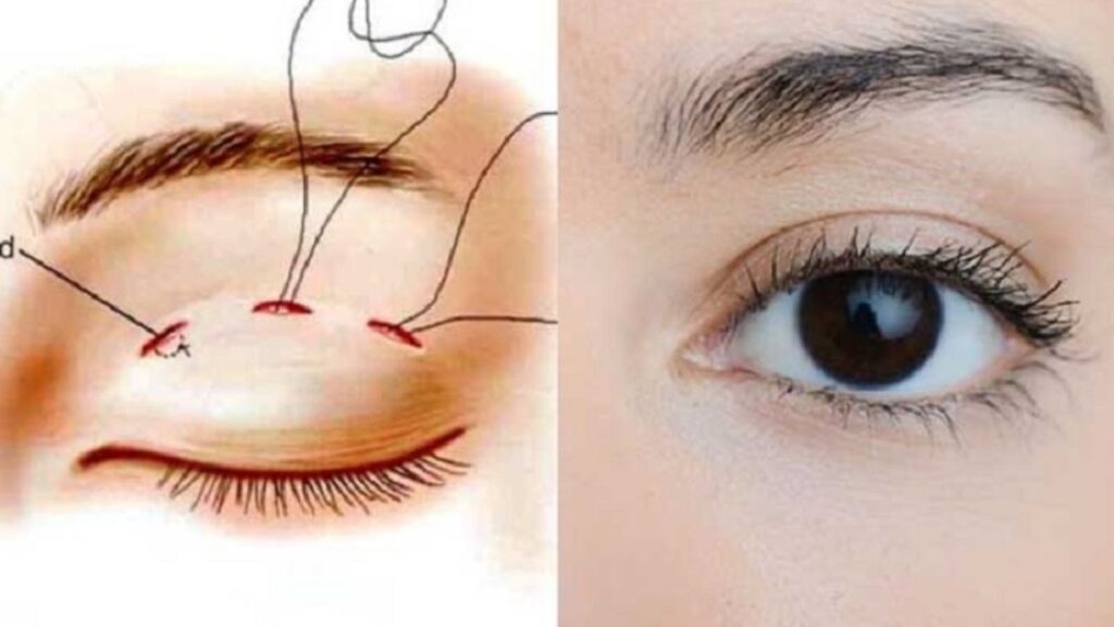 Nhấn mí Hàn Quốc là gì? Phương pháp tạo nếp mí tự nhiên, không cần phẫu thuật