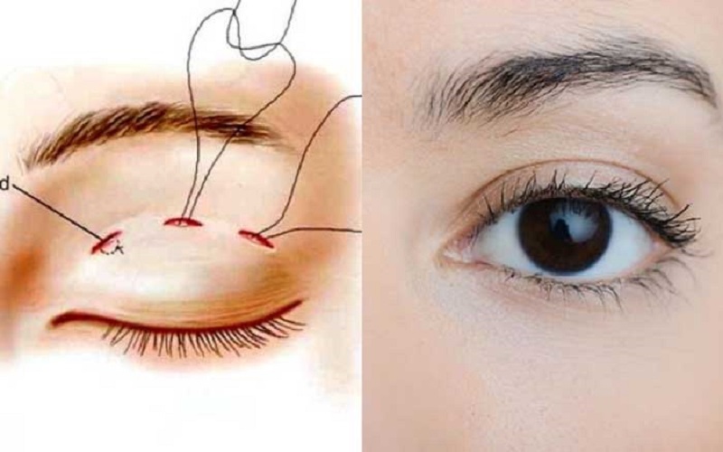 Nhấn mí chỉ cần luồn chỉ qua 3 - 5 điểm đã bấm, không cần phẫu thuật cắt da