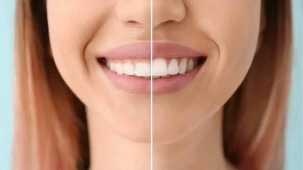 Phẫu thuật cười hở lợi là gì? So sánh các kỹ thuật điều trị phổ biến