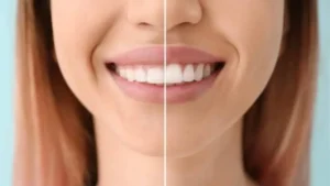 Phẫu thuật cười hở lợi là gì? So sánh các kỹ thuật điều trị phổ biến