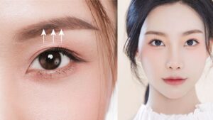 Sụp mí mắt là gì? Nguyên nhân, mức độ và hướng điều trị