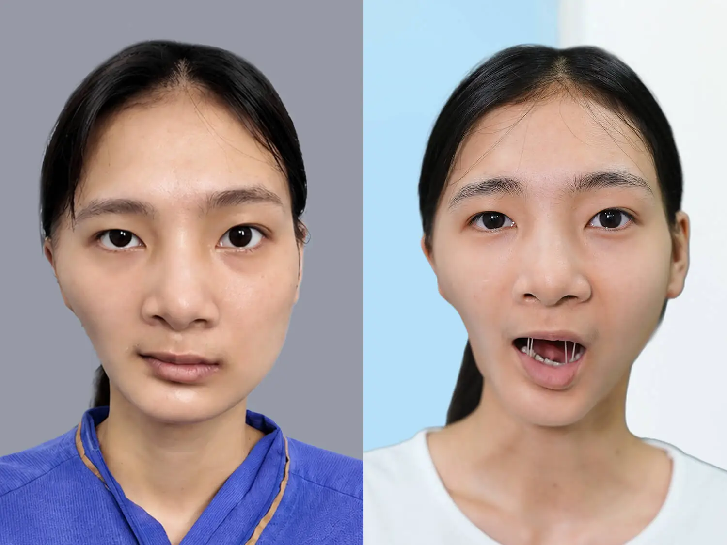 Nguyễn Thị Diệu gặp tình trạng mặt không cân đối nghiêm trọng do thiếu sản và biến dạng xương mặt. Sau 60 ngày, tình trạng mặt không cân đối đã cải thiện rõ, trục hàm và khớp cắn bước đầu ổn định