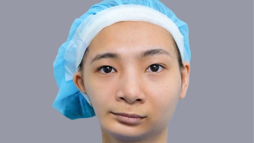 Tái phẫu thuật hàm mặt: Nguyên nhân, phương pháp và thời gian hồi phục