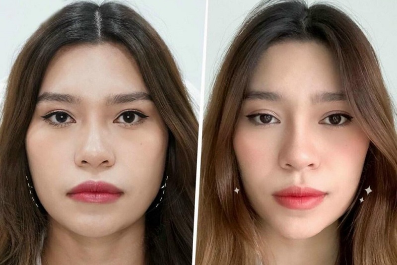 ảnh trước và sau khi tiêm botox gọn hàm của khách hàng, gương mặt thon gọn, cân đối hơn