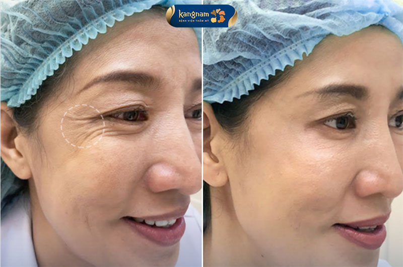 khách hàng có đuôi mắt xuất hiện vết chân chim, thực hiện tiêm botox nâng cung chân mày cải thiện nếp nhăn