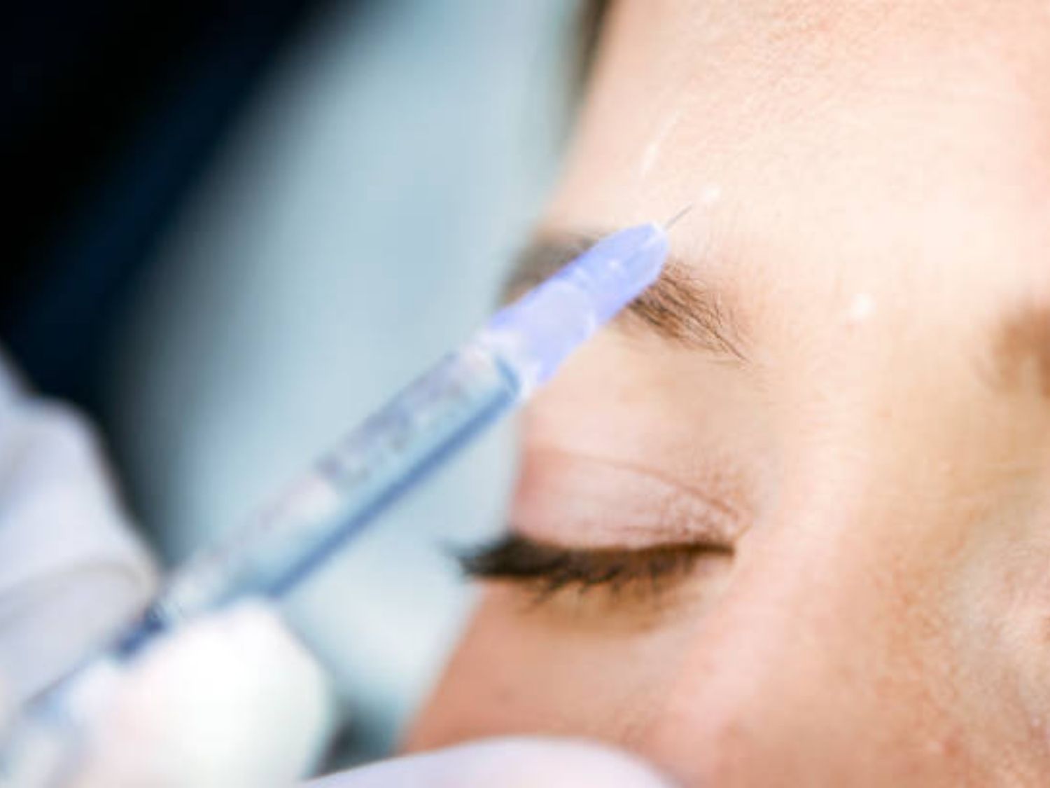Tiêm botox nâng cung mày sử dụng độc tố Botulinum Toxin type A đã qua tinh chế để tiêm vào các nhóm cơ nhất định quanh vùng mắt