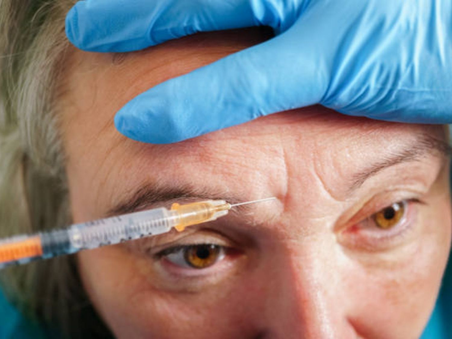 Tiêm Botox Trẻ Hóa cho vùng trán bị nhăn của khách hàng trung niên