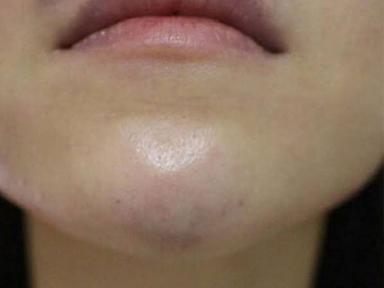 Tình trạng vón cục sau khi tiêm filler cằm