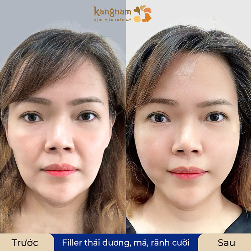 Khách hàng má hóp, thái dương lõm và rãnh cười sâu. Sau khi tiêm filler gương mặt trẻ ra đến 10 tuổi