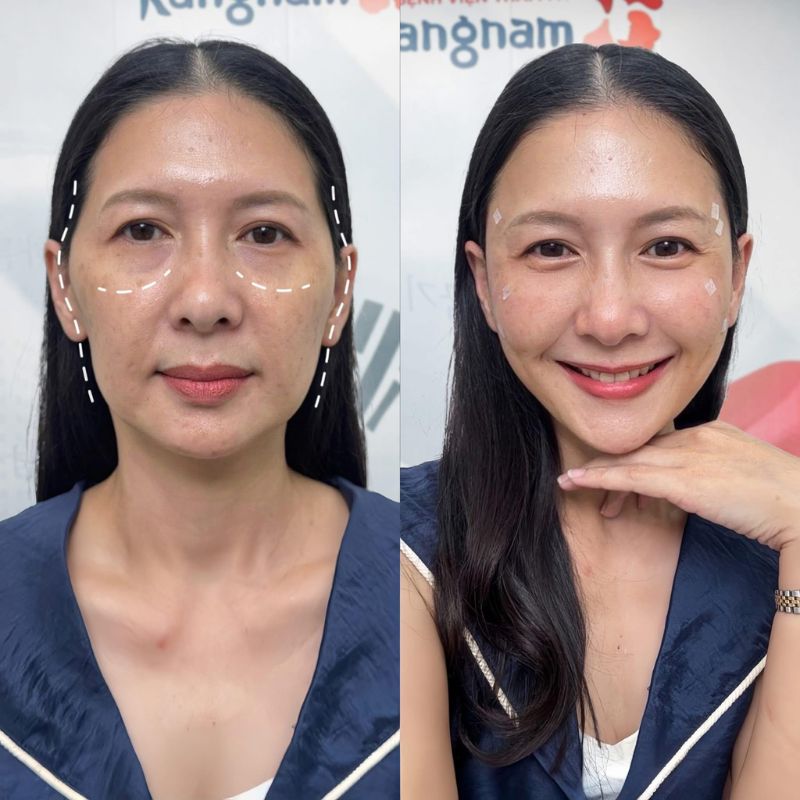 khách hàng sau khi tiêm filler sở hữu gương mặt trẻ trung và tươi tắn hơn, filler duy trì ổn sau 15 tháng