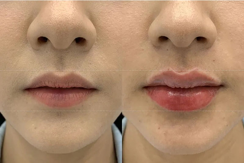 khách hàng môi mỏng sau khi tiêm filler sở hữu môi căng mọng quyến rũ