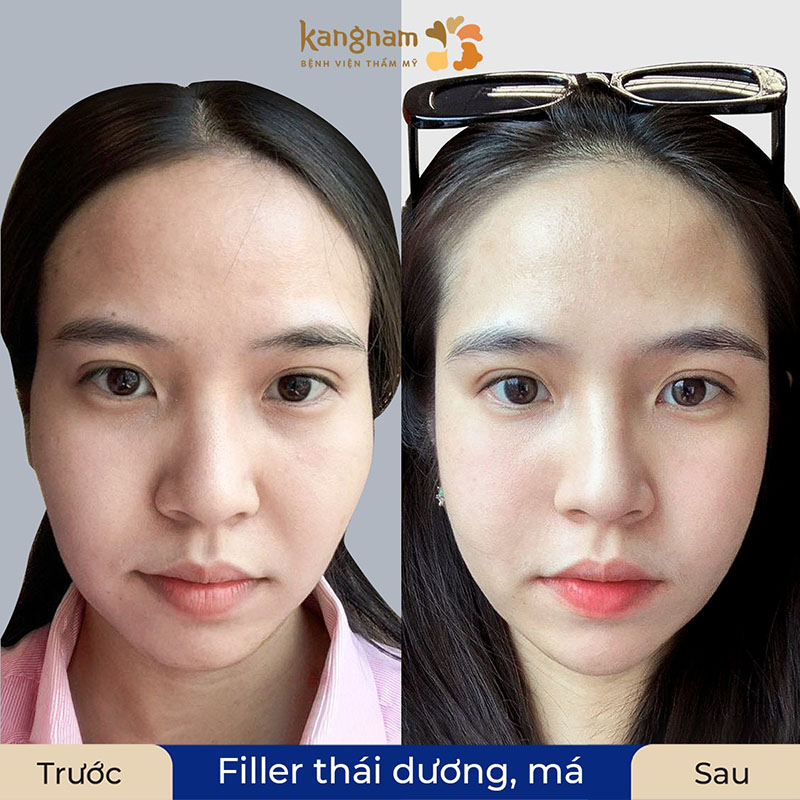 người có ms hóp, rãnh rồng, thái dương lõm có thể cân nhắc tiêm filler. Ảnh trước và sau tiêm của khách hàng