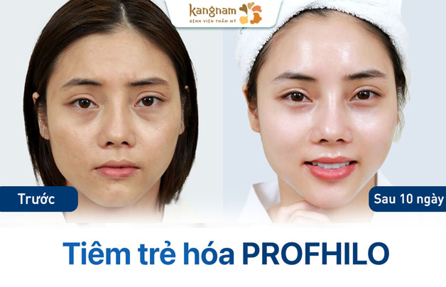 khách hàng da sạm, tối màu, sau khi tiêm da căng mọng, sáng và gương mặt trẻ hơn