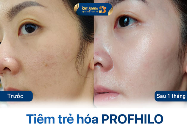 khách hàng trên 30 tuổi da chùng nhão, sạm và không đều màu. Sau khi tiêm profhilo sở hữu làn da căng mịn, sáng hơn