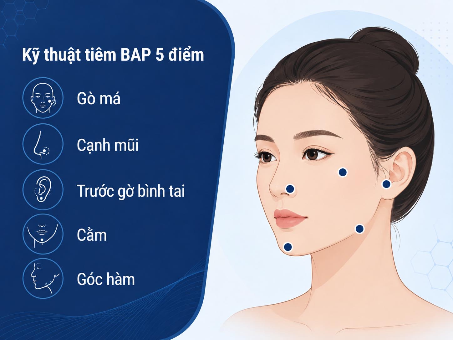 ảnh mô tả Kỹ thuật tiêm BAP 5 điểm