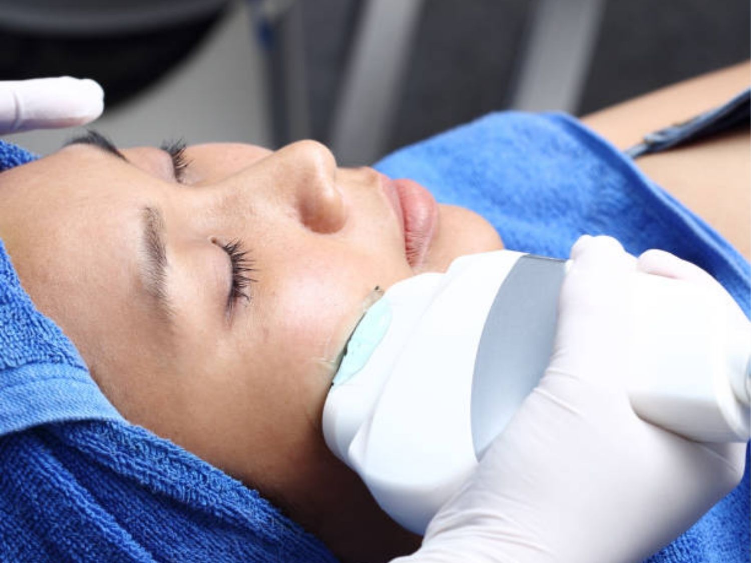 Trẻ hóa da HIFU sử dụng sóng siêu âm hội tụ cường độ cao tác động vào các lớp sâu dưới da