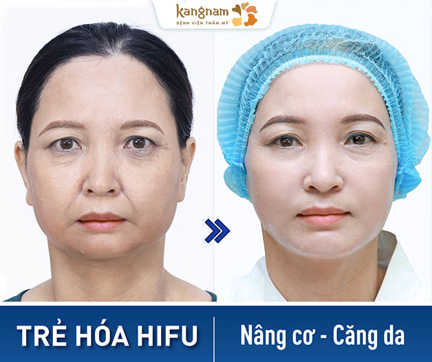 Nâng cao vùng cơ mặt bị chảy xệ, gương mặt thon gọn và trẻ trung