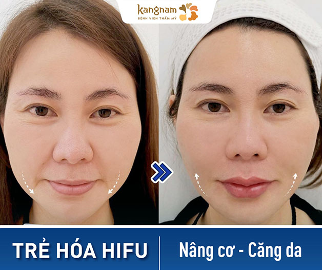 tình trạng Da chùng nhão sau khi hifu sở hữu làn da căng mịn, tự nhiên