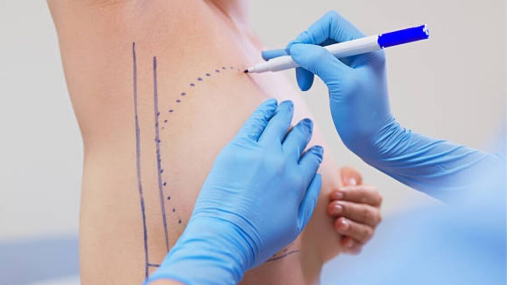 Treo Ngực Không Đặt Túi Là Gì? Giải Pháp Khắc Phục Sa Trễ Tự Nhiên