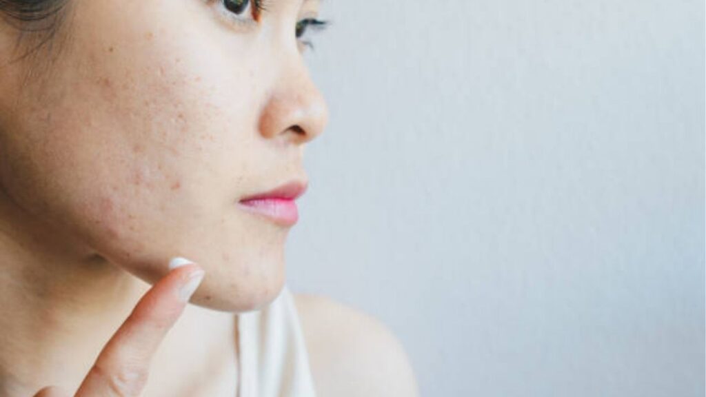 Trị Mụn Chuẩn Y Khoa: Nguyên Nhân, Phương Pháp Và Quy Trình Điều Trị Hiệu Quả