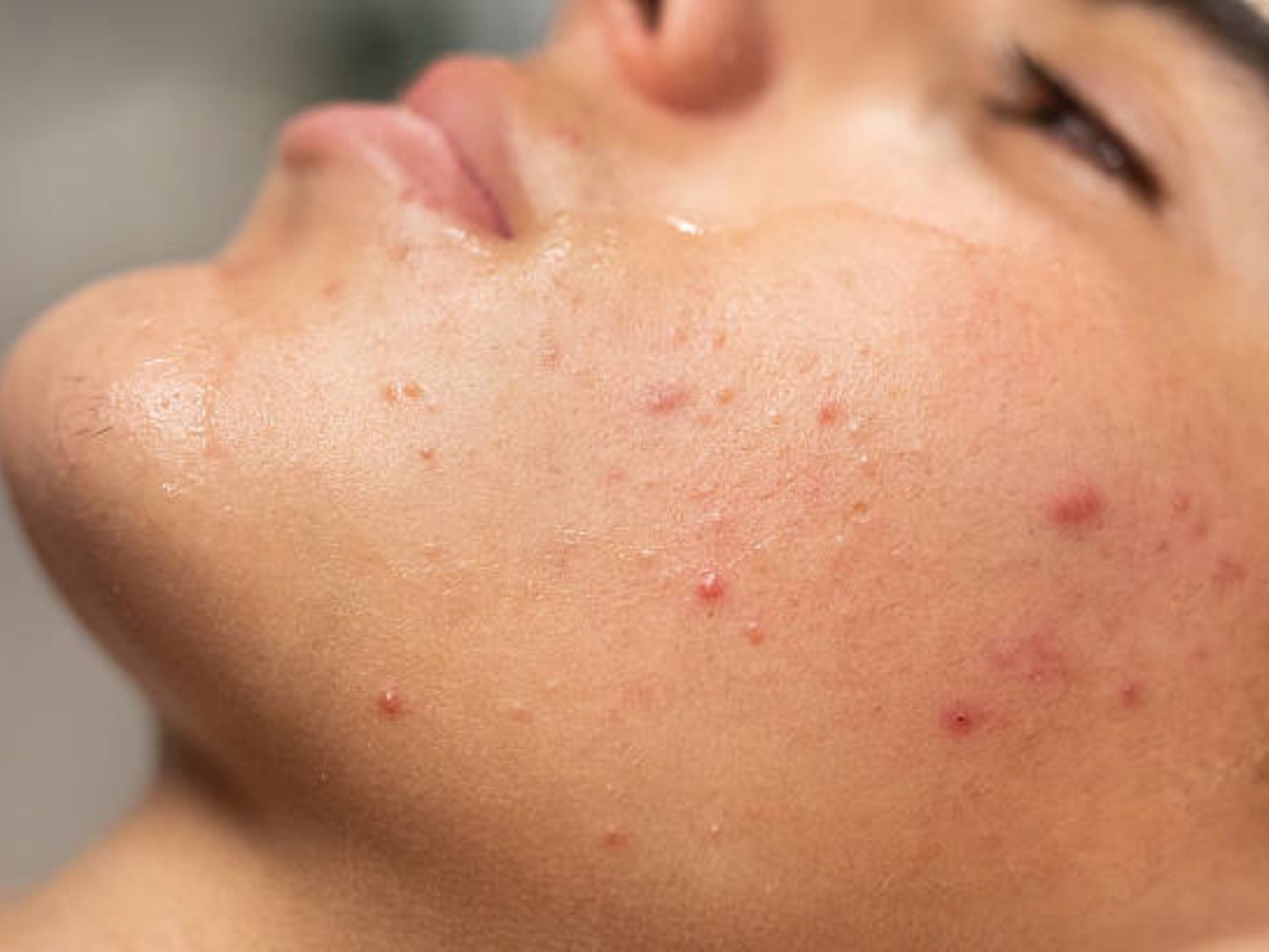 Mụn bọc là tình trạng viêm nhiễm sâu dưới bề mặt da. các khối sưng đỏ, cứng, gây đau nhức