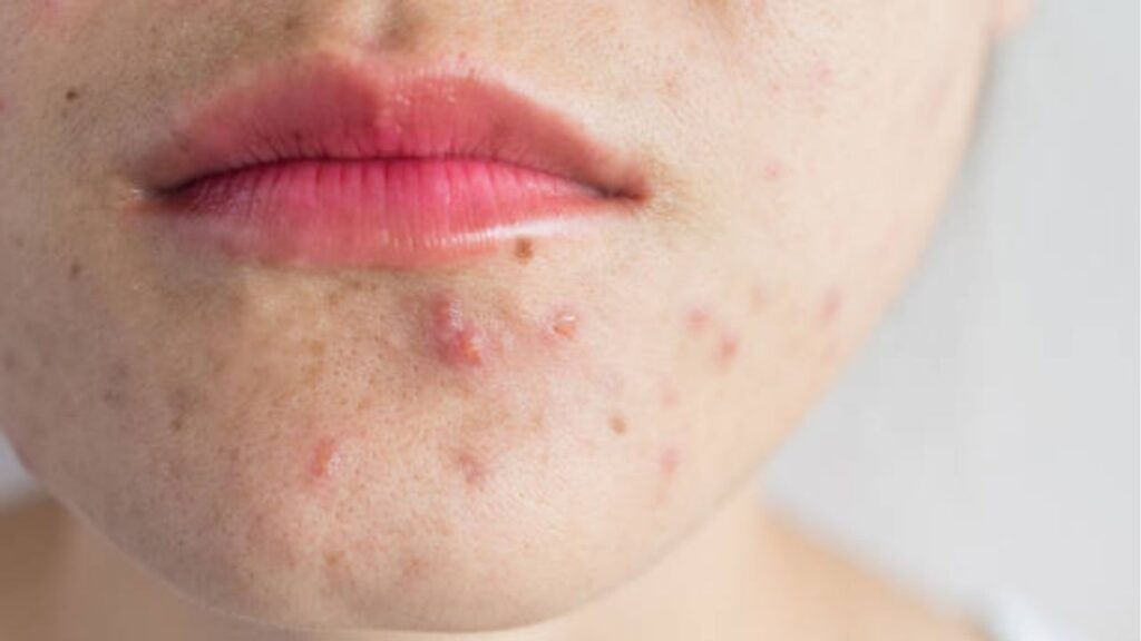 Trị mụn bọc nhanh và an toàn: Khi nào cần gặp bác sĩ da liễu?