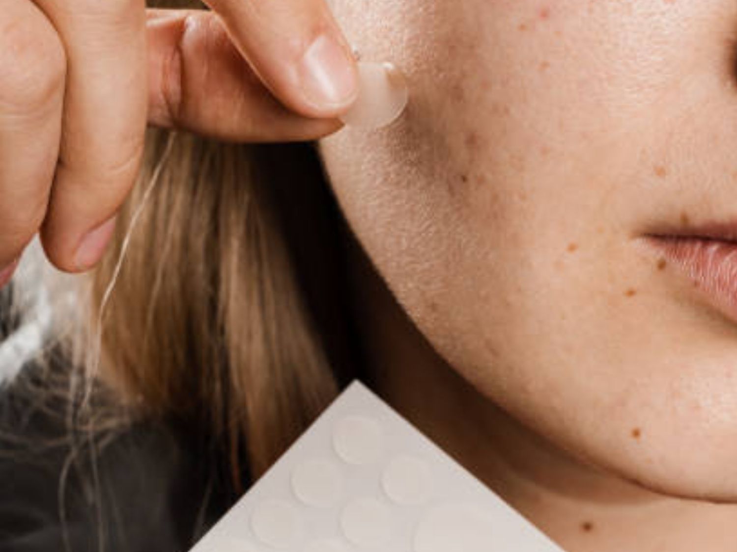 Lạm dụng miếng dán hút mụn tạo môi trường yếm khí hoàn hảo cho vi khuẩn C. acnes sinh sôi nhanh hơn