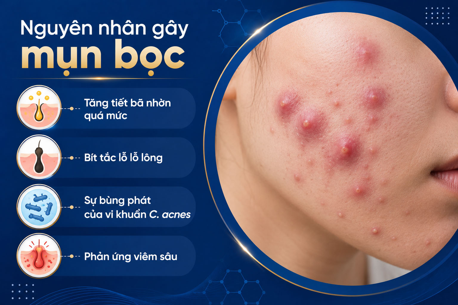ảnh mô tả các Nguyên nhân gây mụn bọc