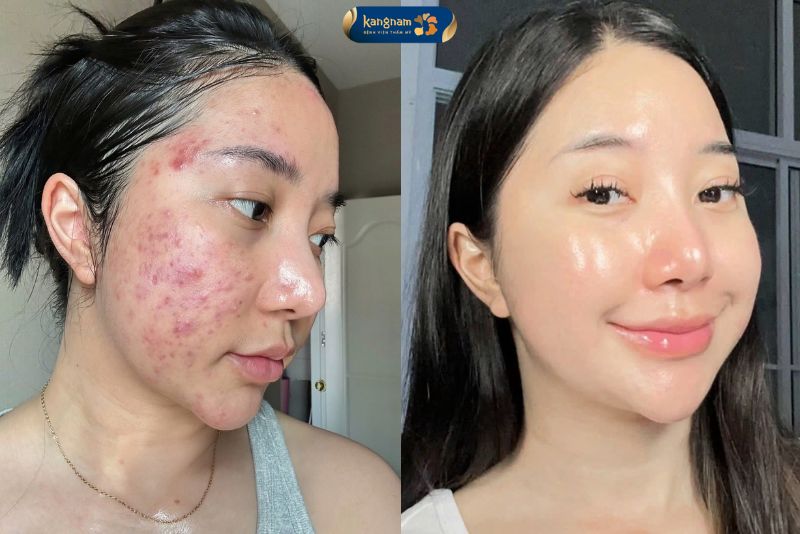 ảnh khách trước và sau khi điều tri mụn thành công tại Kangnam