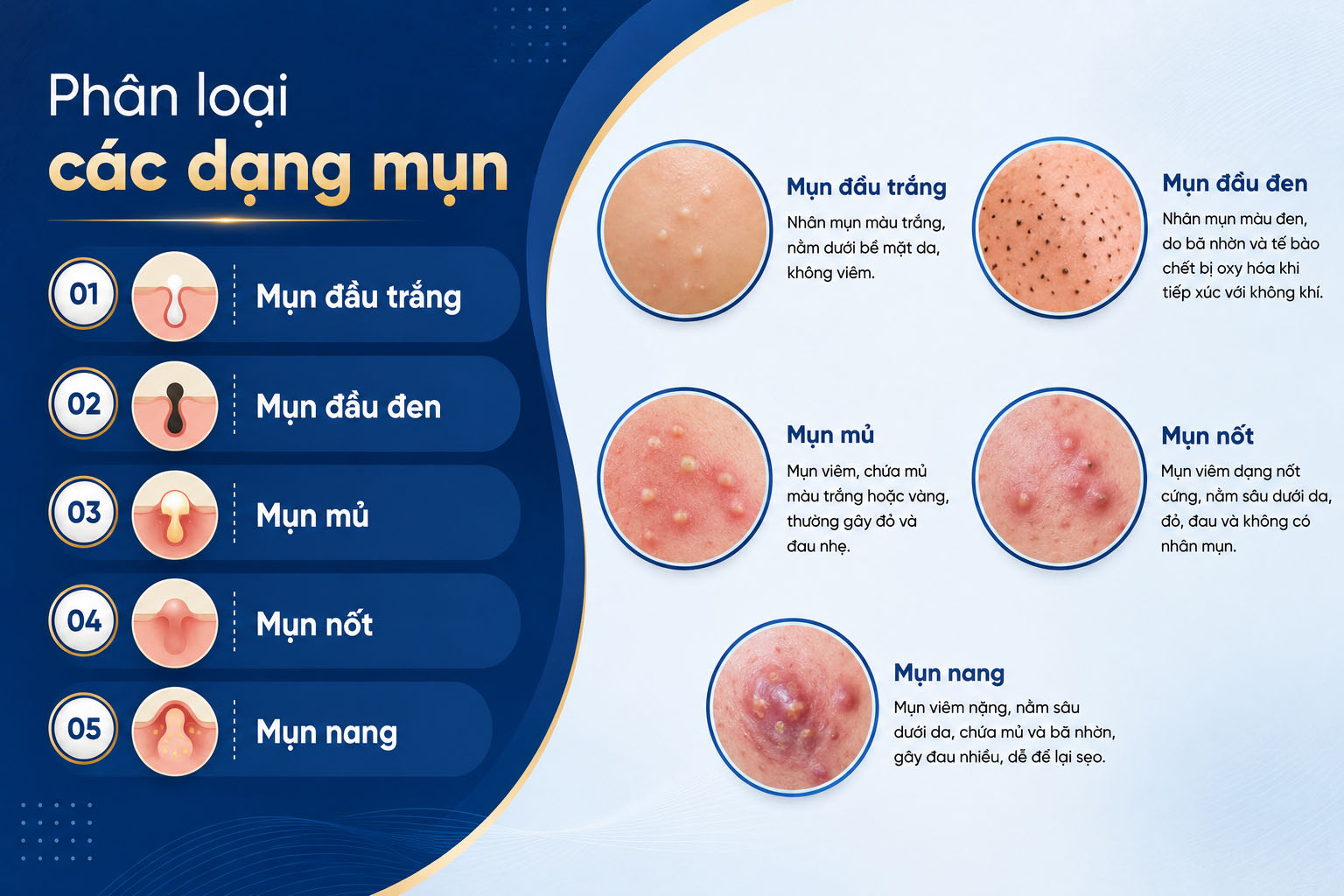 ảnh mô tả Phân loại các dạng mụn thường gặp và mức độ nghiêm trọng