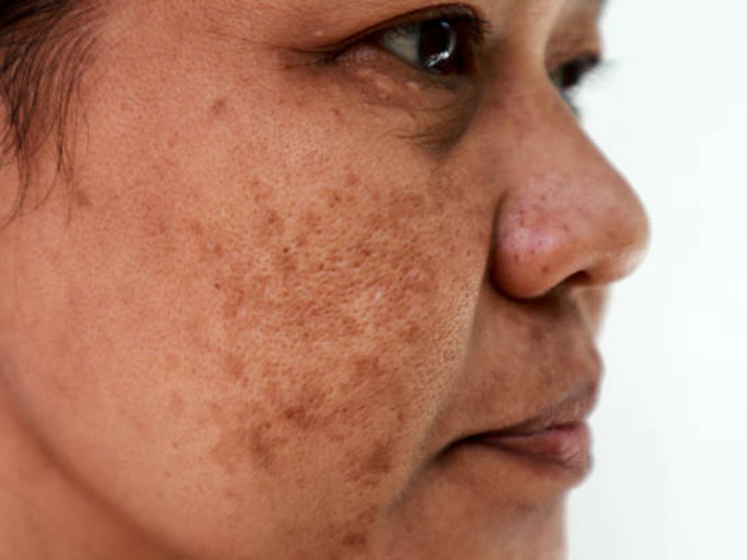 Nám da (melasma) hình thành do sự gia tăng quá mức của tế bào sắc tố, tạo nên các mảng sắc tố sẫm màu