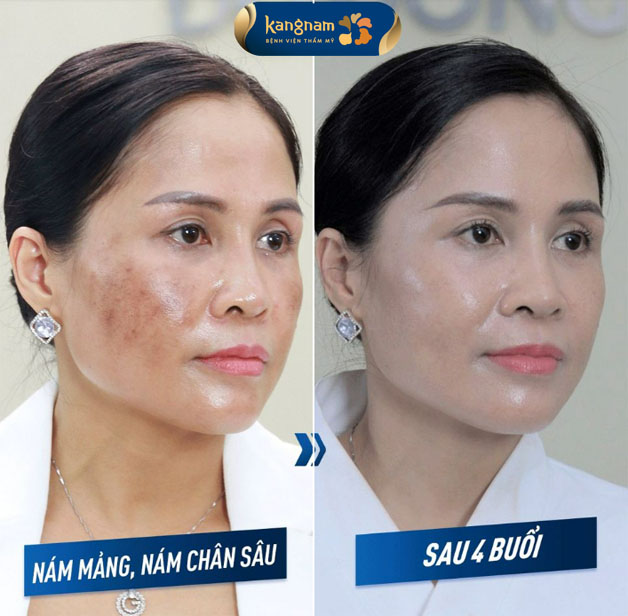 khách hàng trước và sau khi trị nám bằng laser tại Kangnam