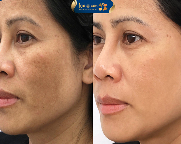ảnh trước sau của khách hàng sau 1 liệu trình trị nám mảng tại Kangnam, da sáng khỏe, hết sắc tố