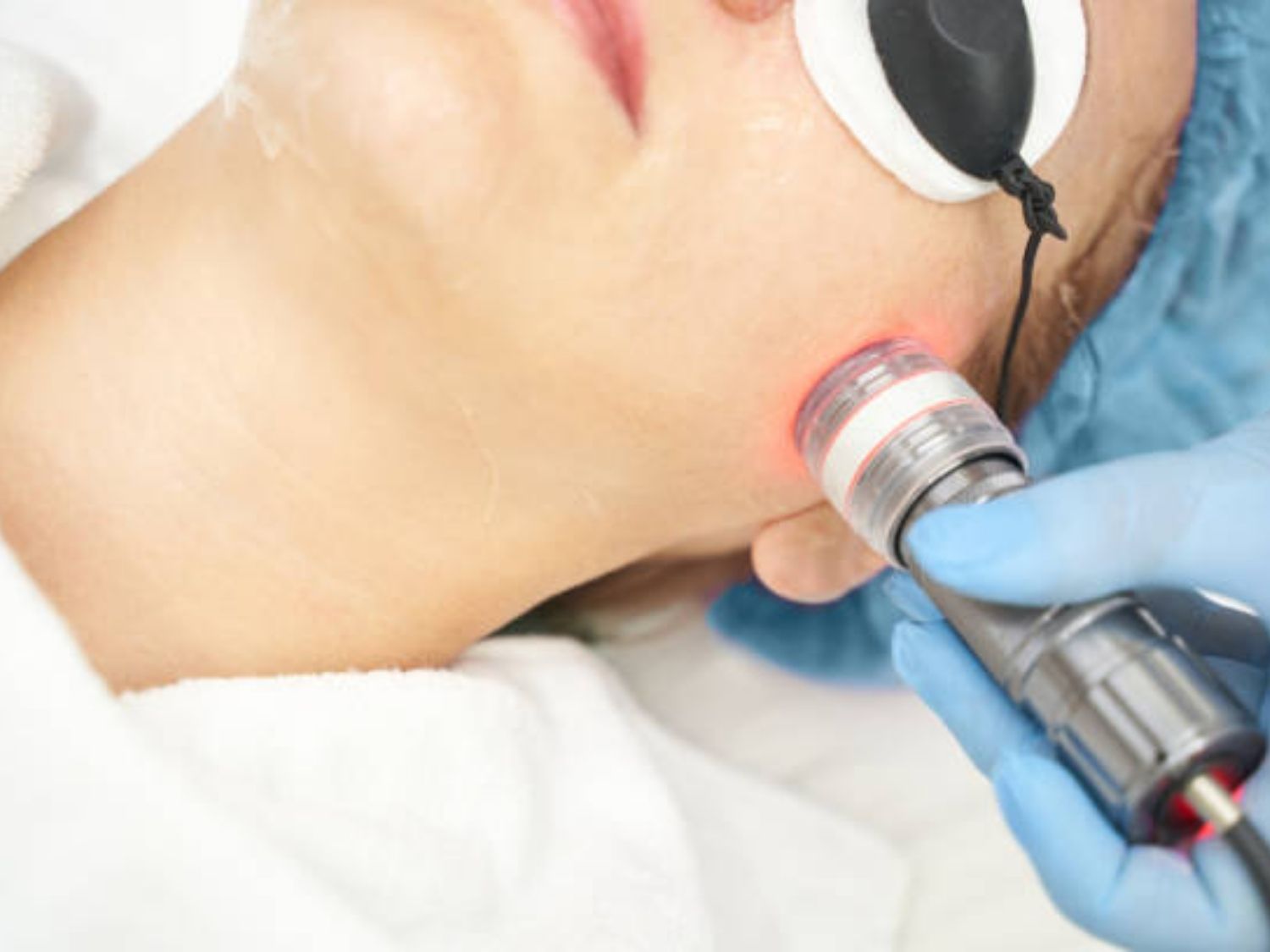 Laser và công nghệ ánh sáng trị nám mảng tầng sâu