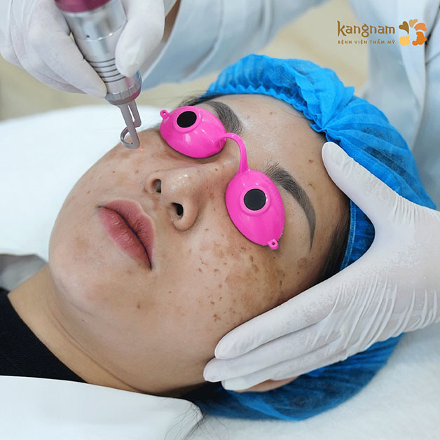 Laser điều trị sắc tố tác động trúng đích vào các đốm sắc tố và loại bỏ ra khỏi da