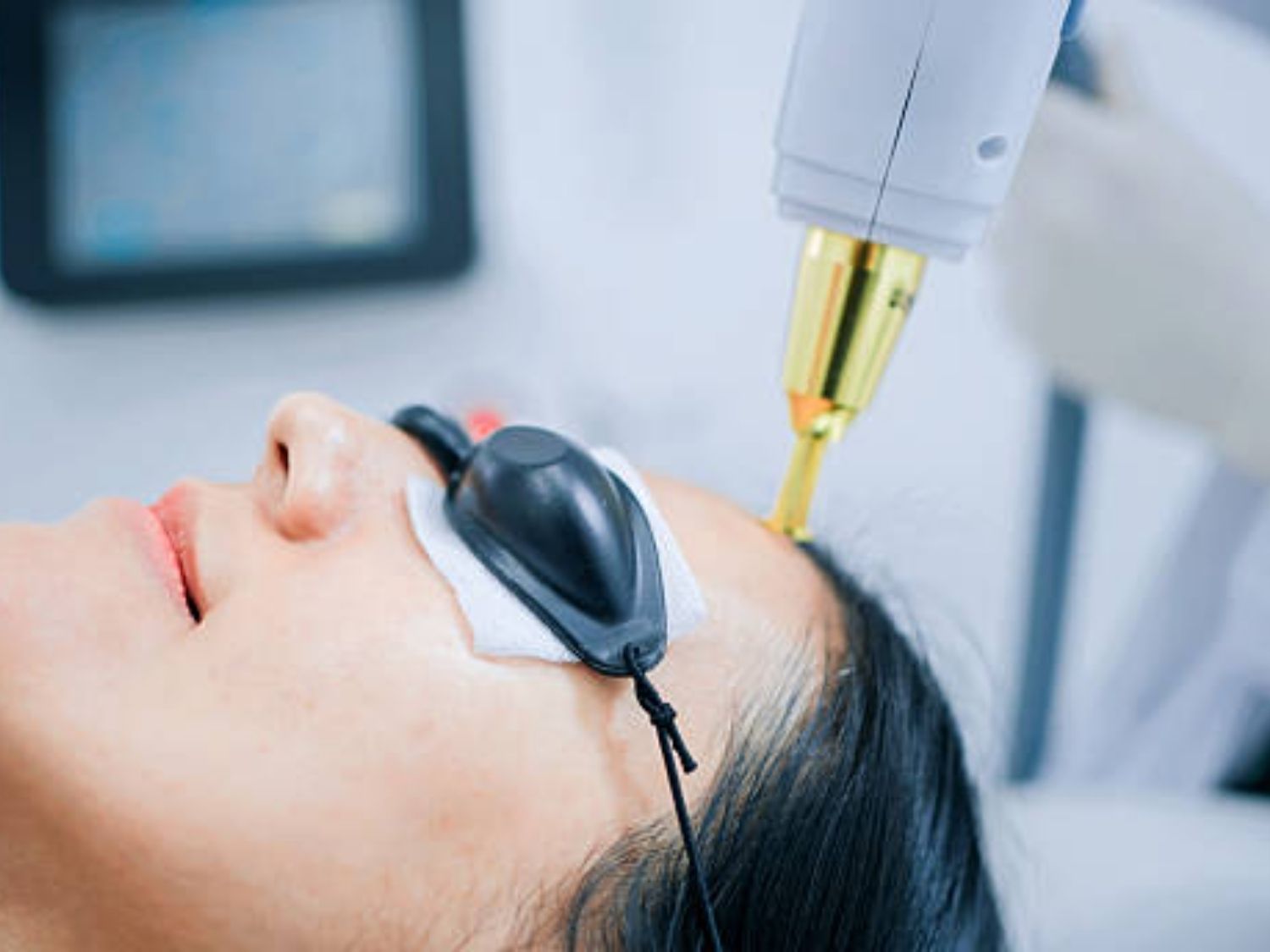 Laser và công nghệ ánh sáng xóa nám tầng sâu