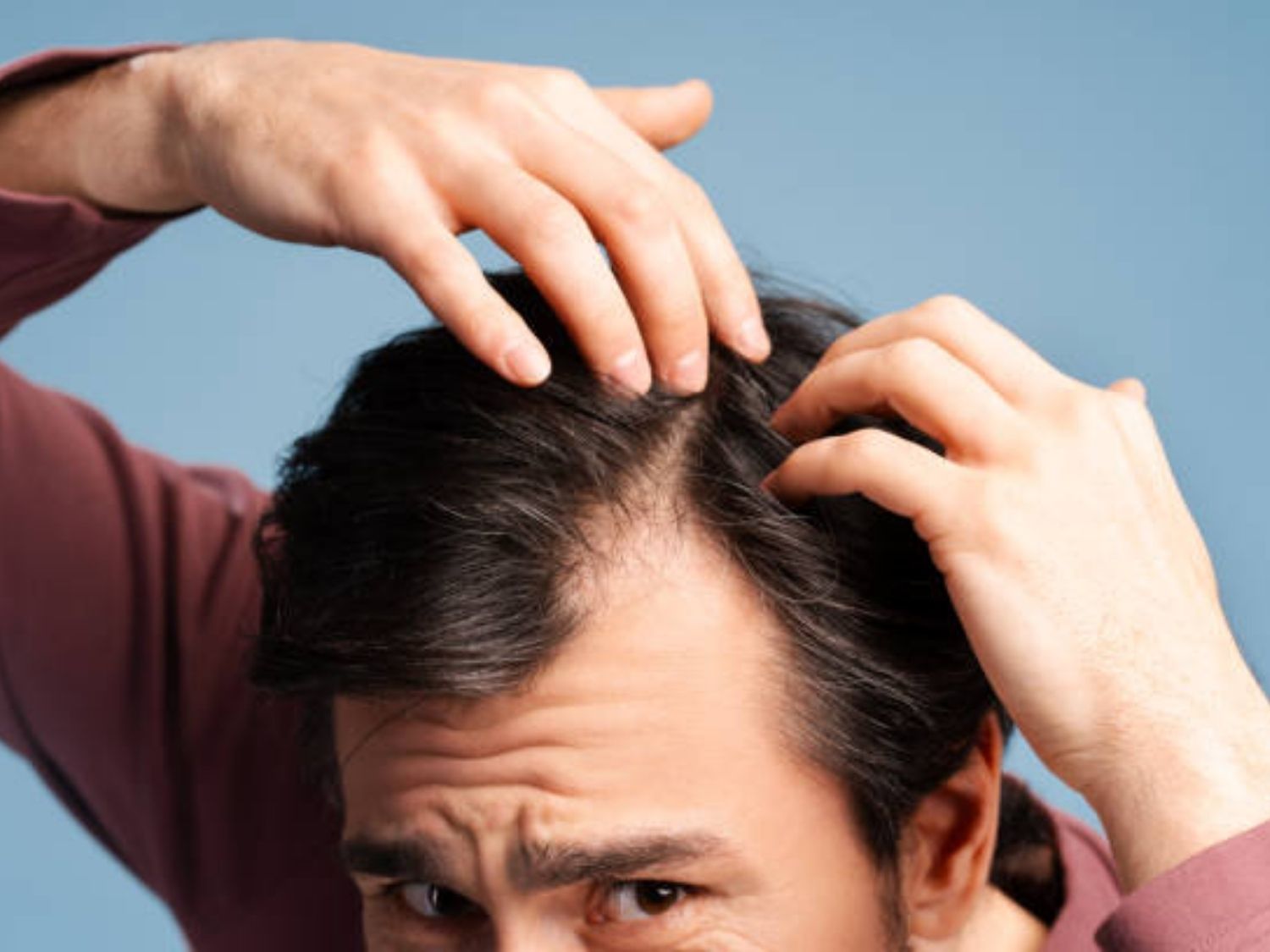 rụng tóc tạo trán hữ M ở nam giới khiến gương mặt trông già hơn tuổi thật