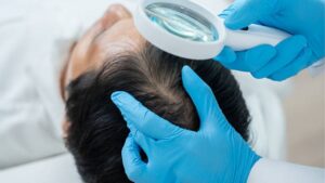 Trị rụng tóc do nội tiết: Nguyên nhân, phương pháp và phòng tránh rụng tóc