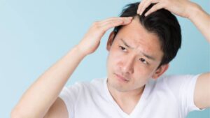 Trị rụng tóc nam: 8 cách giảm rụng, kích thích mọc tóc hiệu quả