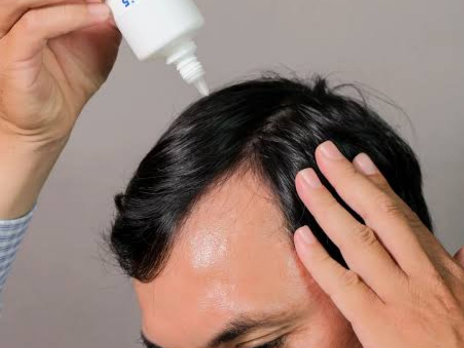 Dùng minoxidil theo hướng dẫn để trị rụng tóc ở đỉnh đầu nam giới