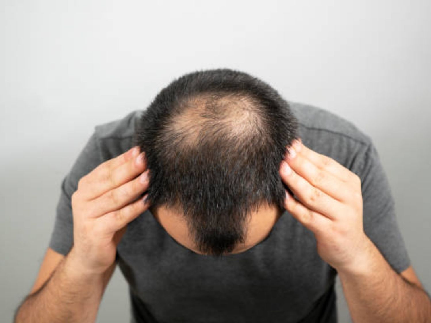 tình trạng rụng tóc đỉnh đầu và trán khiến người bệnh mệt mỏi và tự ti