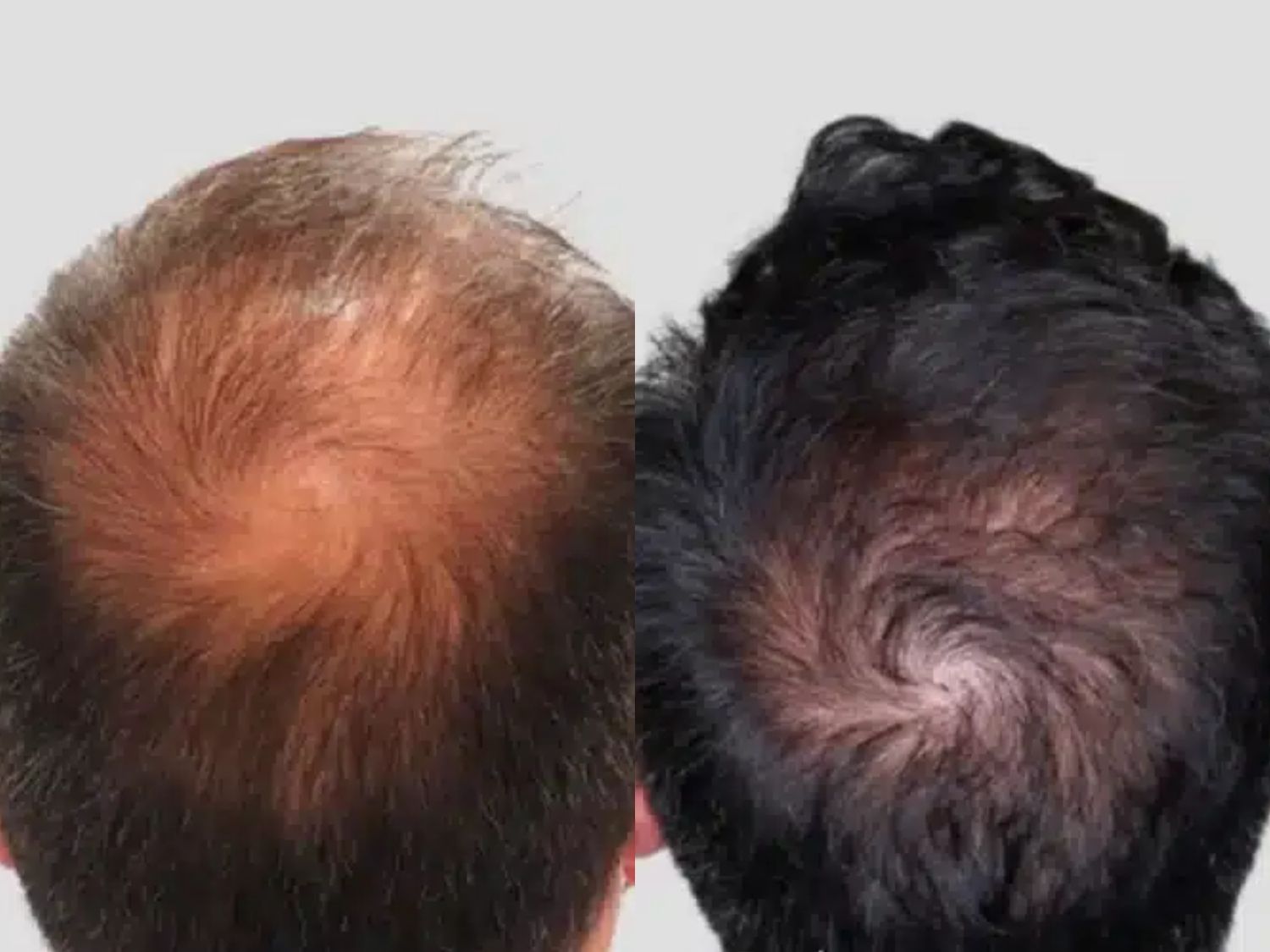 khách hàng nam giới trước và sau khi cấy tóc tại Kangnam, phần đỉnh đầu và trán mọc tóc dày hơn