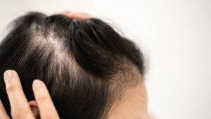 Trị rụng tóc nữ: Nguyên nhân, cách cải thiện và giải pháp phục hồi mái tóc chắc khỏe