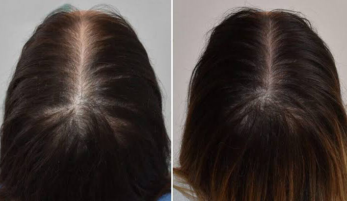 ảnh trước và sau khi trị rụng tóc bằng meso của khách hàng, tóc mọc dày và cứng hơn