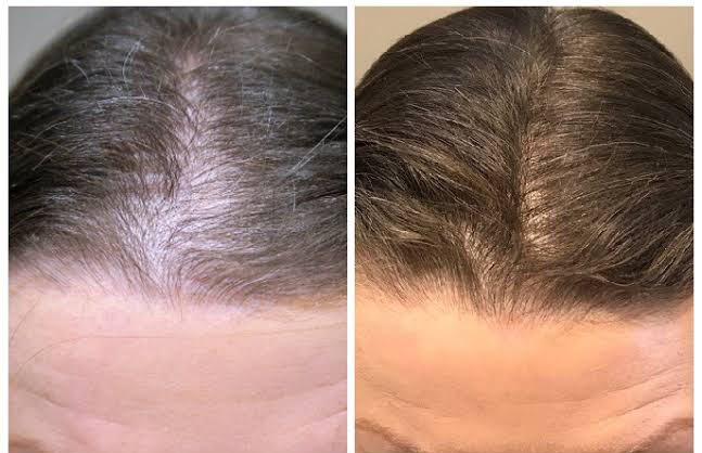 khách hàng sau khi trị rụng tóc, tình trạng hói đỉnh đầu đã cải thiện đáng kể